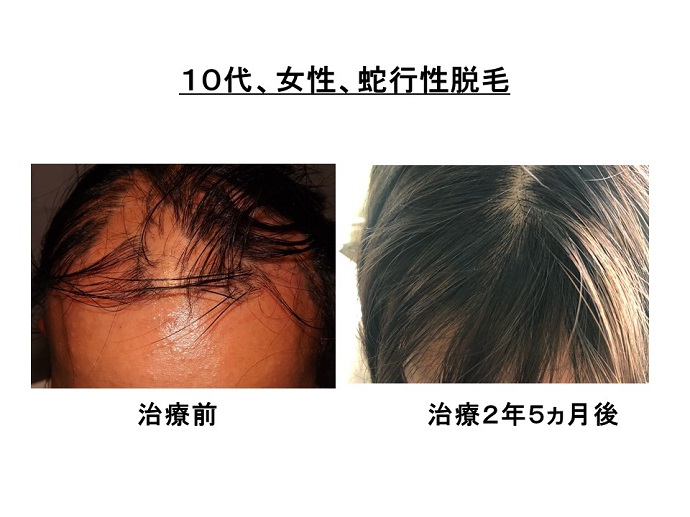 円形脱毛症　病院